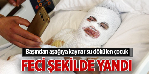 Başından aşağıya kaynar su dökülen çocuk feci şekilde yandı