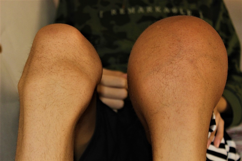 (Özel) Kemik kanseri olan Mustafa yardım bekliyor